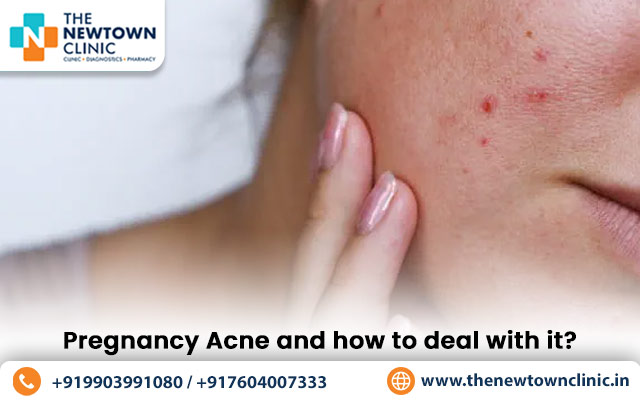 Pregnancy Acne and how to deal with it?