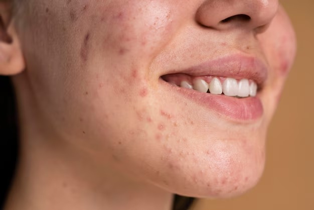 Acne Acne