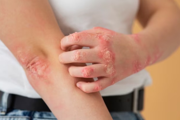 Bacterial or Fungal Skin Infections Bacterial or Fungal Skin Infections