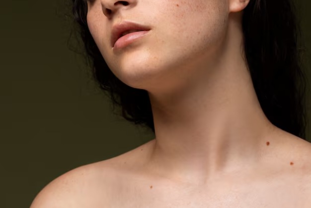 Hyperpigmentation Hyperpigmentation