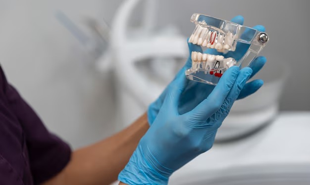 Advantages of Dental Implants Advantages of Dental Implants