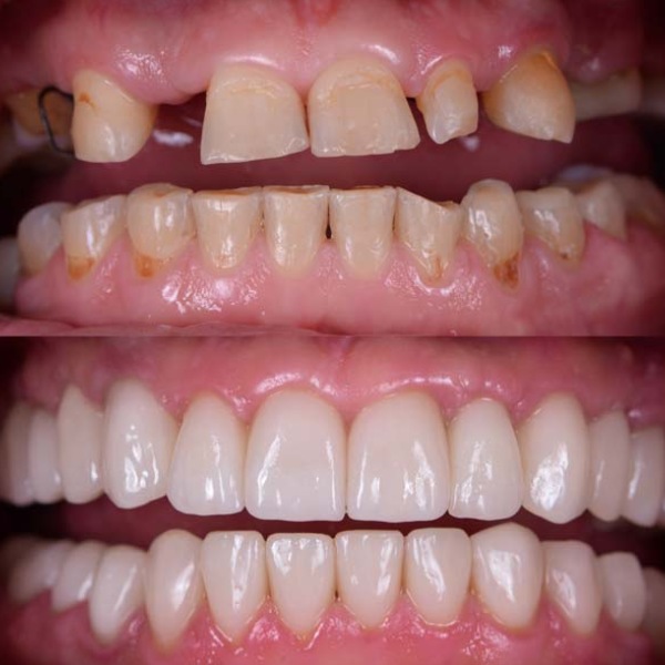 Cosmetic Dentistry Before and After Cosmetic Dentistry Before and After