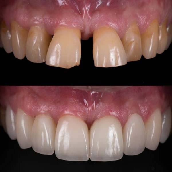 Cosmetic Dentistry Before and After Cosmetic Dentistry Before and After