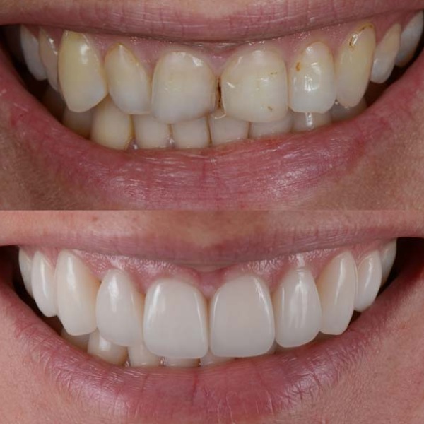 Cosmetic Dentistry Before and After Cosmetic Dentistry Before and After