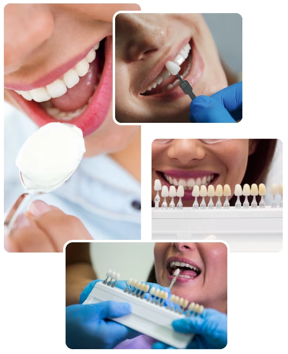 Teeth Whitening Procedure Teeth Whitening Procedure