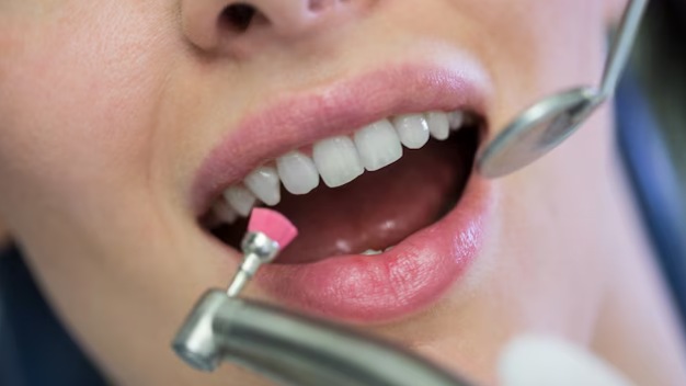 Professional Teeth Whitening Treatment Professional Teeth Whitening Treatment