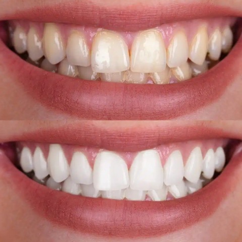 Teeth Whitening Before and After Teeth Whitening Before and After
