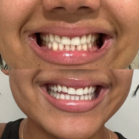 Teeth Whitening Before and After Teeth Whitening Before and After