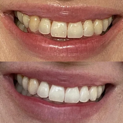 Teeth Whitening Before and After Teeth Whitening Before and After