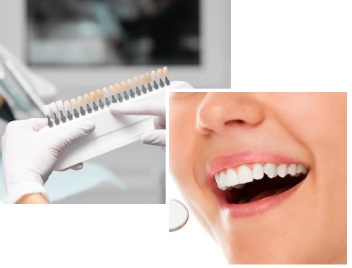 Types of Teeth Stains Types of Teeth Stains